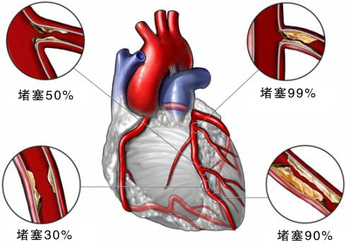 心腦血管疾病_TCD_多普勒.jpg